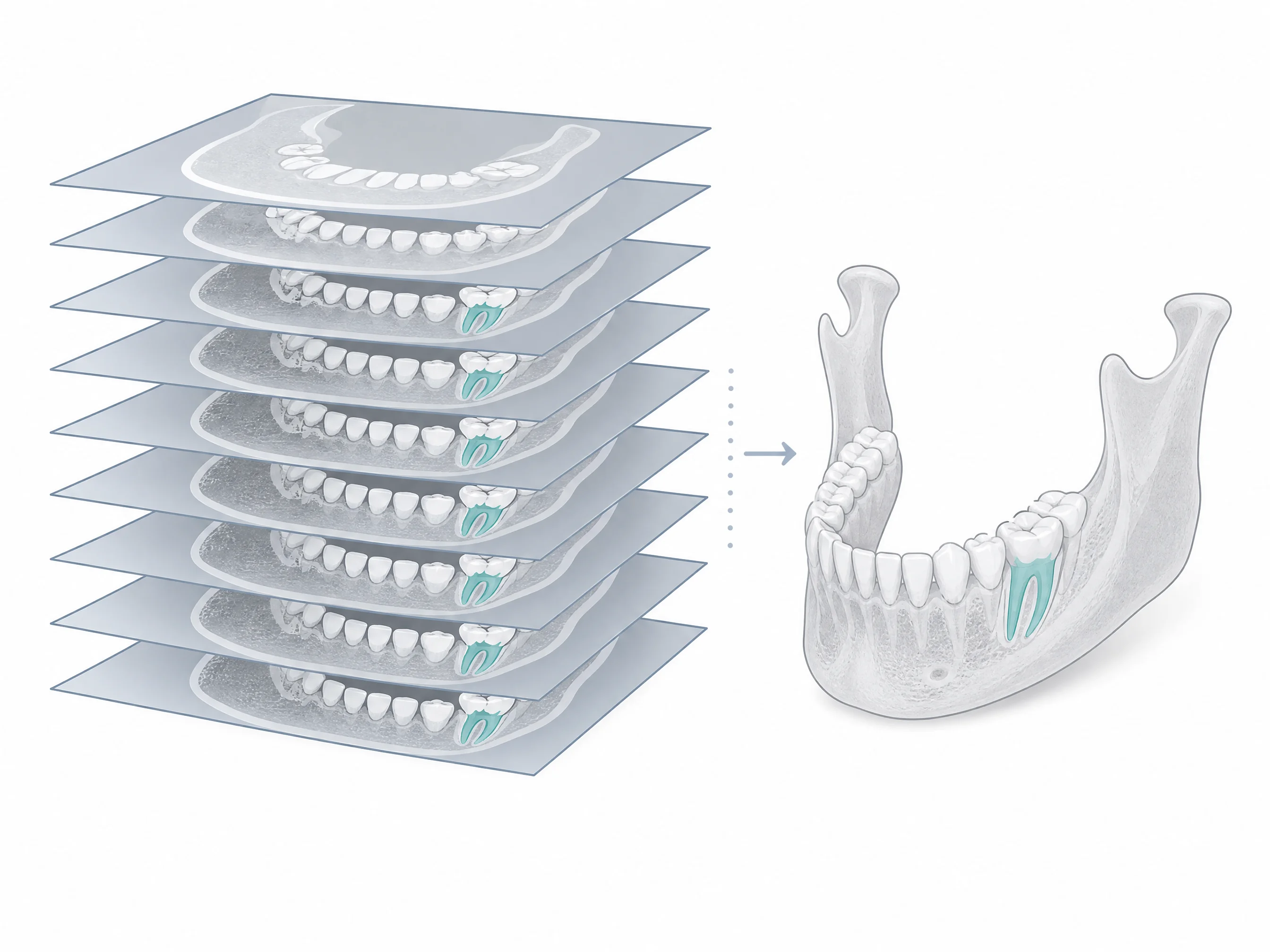 Gömülü 20 yaş dişi ve sinir kanalı ilişkisini üç boyutlu gösteren CBCT tomografi şeması