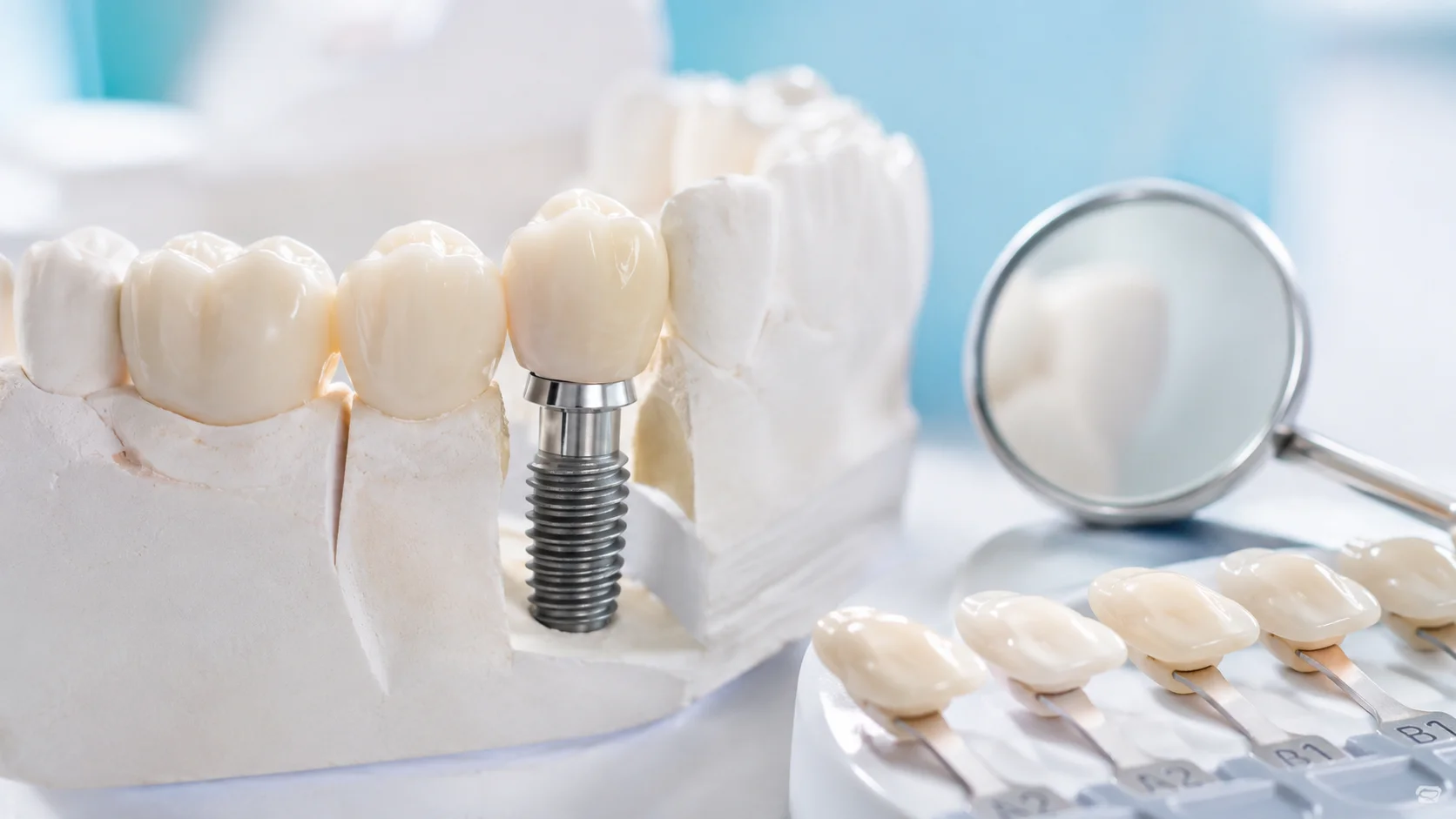 İmplant protez aşaması: abutment ve porselen kron