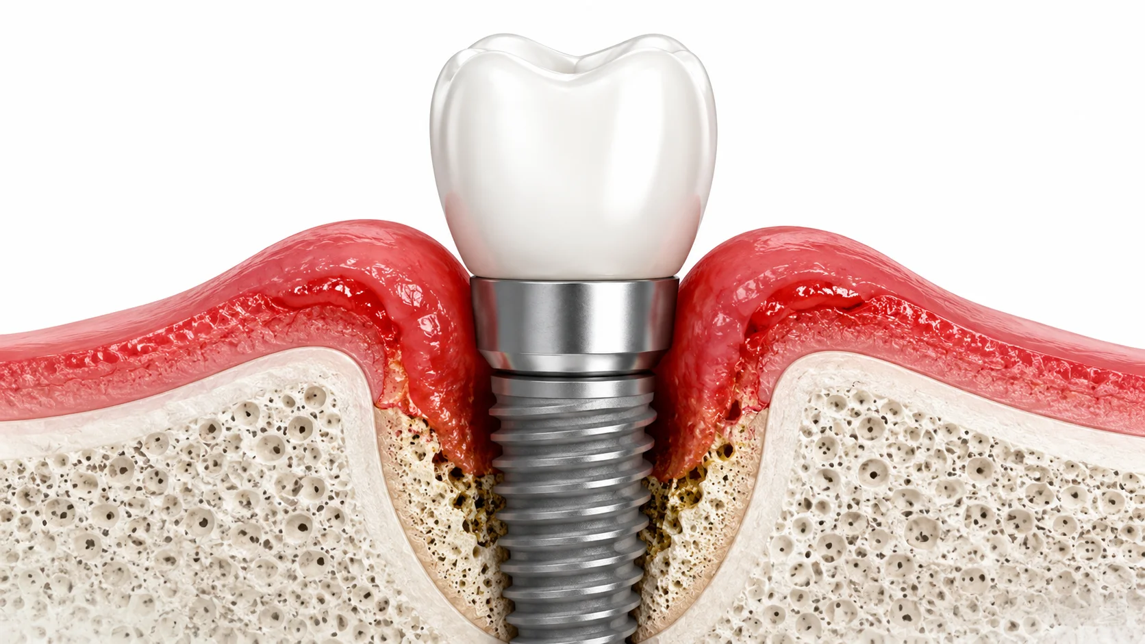 Periimplantitisli implantın anatomik kesiti: kemik kaybı ve iltihap